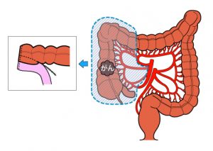 結腸右半切除