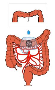 横行結腸切除