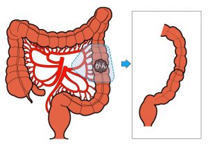 結腸部分切除