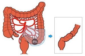 S状結腸切除