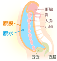 腹水とは