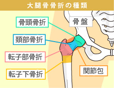 大腿骨骨折の種類