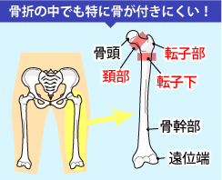 大腿骨骨折は骨折の中でも骨が付きにくい