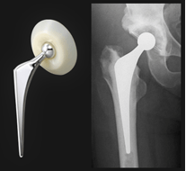 人工物に置き換える方法(人工骨頭挿入術、人工股関節全置換術)