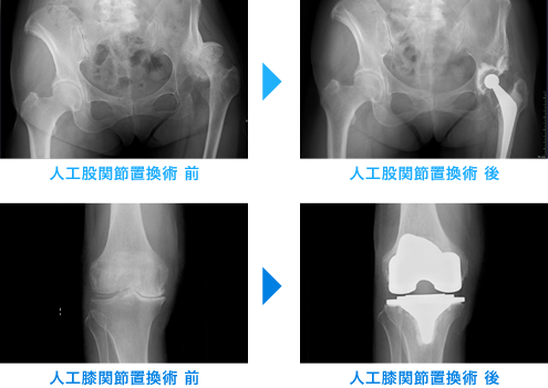 人工膝関節置換術 前後