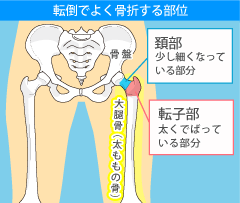 店頭でよく骨折する部位