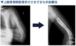 上腕骨骨幹部骨折の様々な手術療法