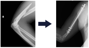 上腕骨骨幹部骨折の様々な手術療法