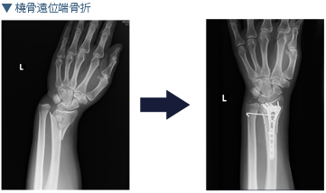 橈骨遠位端骨折