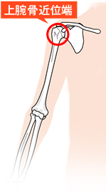 上腕骨近位端骨折とは