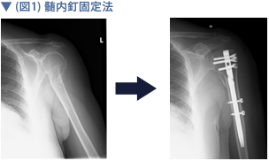 (図1) 髄内釘固定法