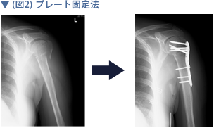 (図2) プレート固定法