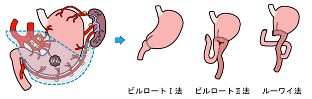 幽門側胃切除再建