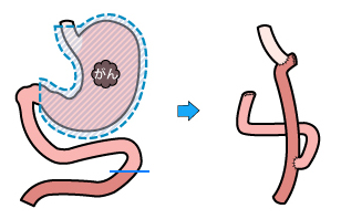 胃全摘再建