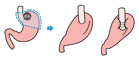 噴門側胃切除再建