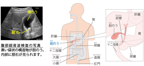 胆石ってなに？