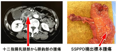 十二指腸乳頭部／SSPPD摘出標本腫瘍