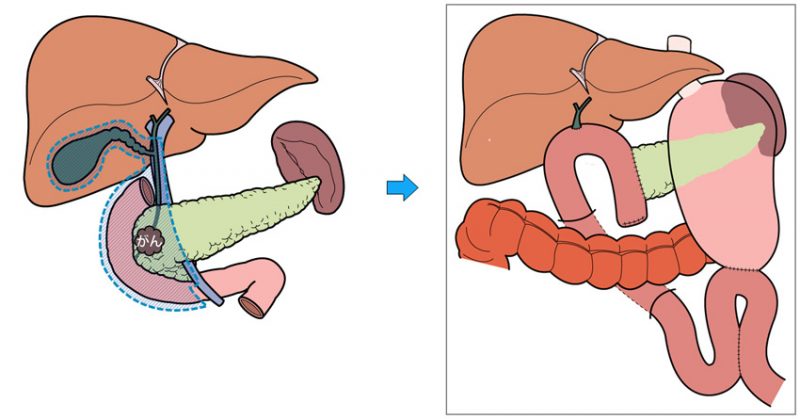 膵頭十二指腸切除