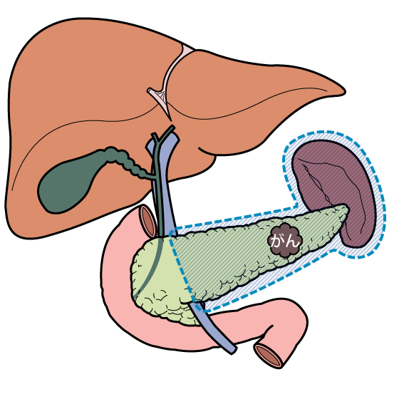 脾合併膵体尾部切除
