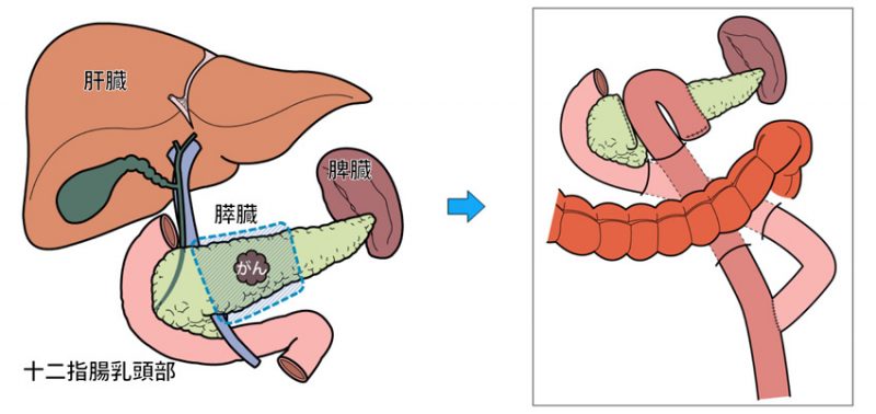 膵中央切除