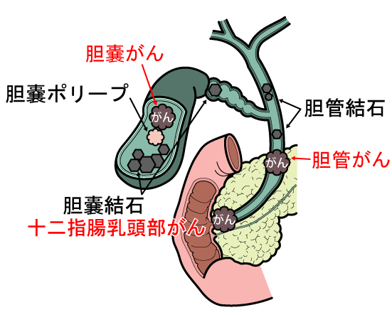 胆管がんとは？