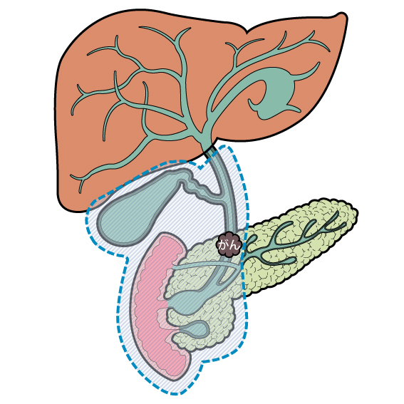 膵頭十二指腸切除