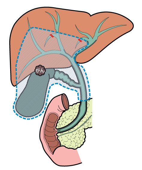 肝S4+S5切除+　胆管切除