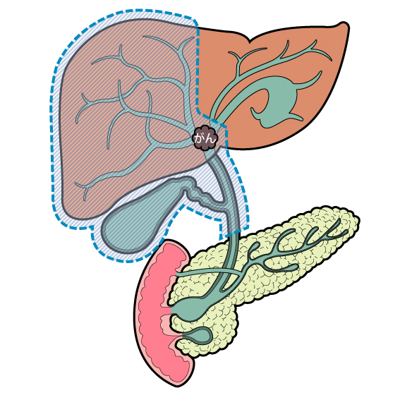 肝右葉切除、胆管切除