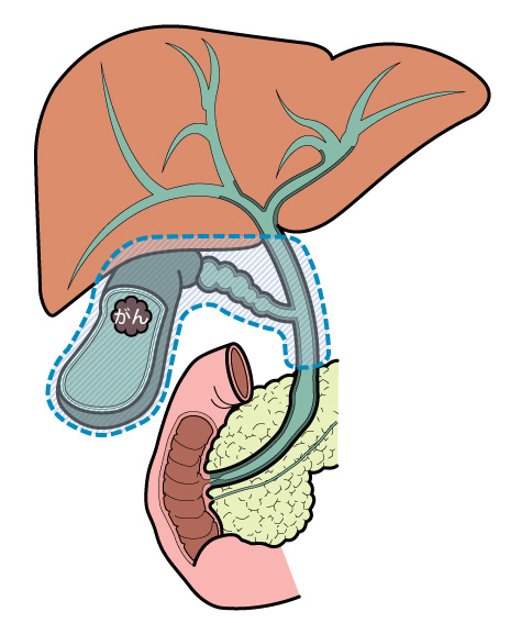 胆嚢床切除+胆管切除