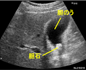 腹部超音波検査