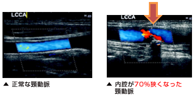 正常な頸動脈と内腔が70％狭くなった頸動脈