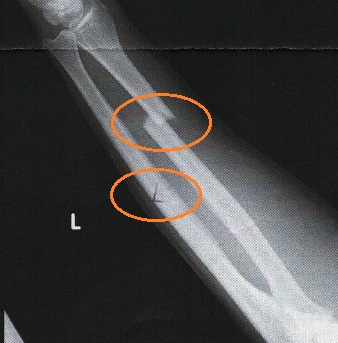 前腕橈尺骨骨折の術後作業療法