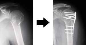 上腕骨近位端骨折術後のリハビリテーション