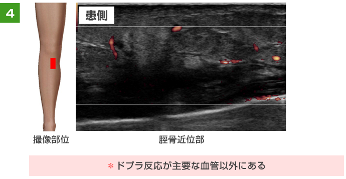 ドプラ反応が主要な血管以外にある