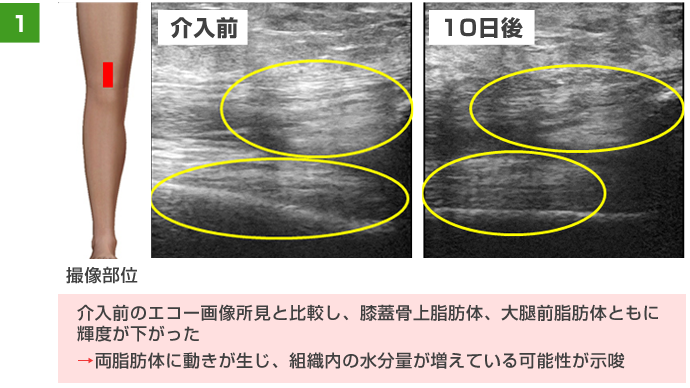 介入前のエコー画像所見と比較し、膝蓋骨上脂肪体、大腿前脂肪体ともに輝度が下がった。→両脂肪体に動きが生じ、組織内の水分量が増えている可能性が示唆。