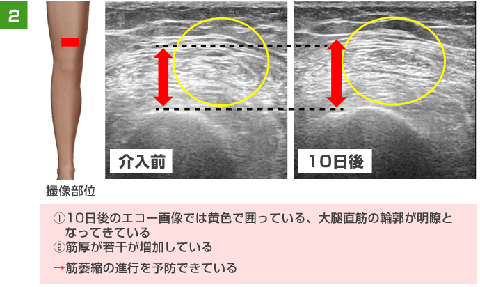 ①10日後のエコー画像では黄色で囲っている、大腿直筋の輪郭が明瞭となってきている。②筋厚が若干が増加している。→筋萎縮の進行を予防できている。