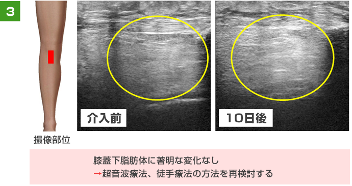 膝蓋下脂肪体に著明な変化なし→超音波療法、徒手療法の方法を再検討する。