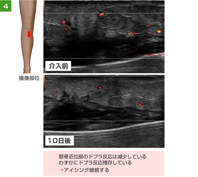 脛骨近位部のドプラ反応は減少している。わずかにドプラ反応残存している。→アイシング継続する。