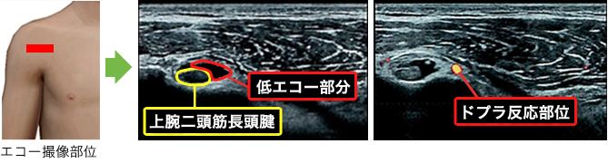 症状：脳梗塞後に麻痺側の肩関節前面に痛みが出現