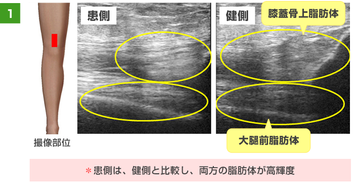 患側は、健側と比較し、両方の脂肪体が高輝度