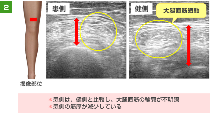 患側は、健側と比較し、大腿直筋の輪郭が不明瞭 患側の筋厚が減少している