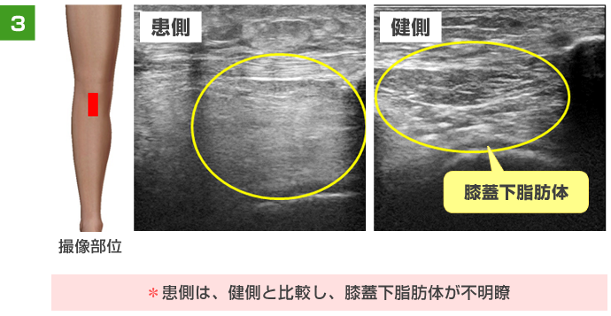 患側は、健側と比較し、膝蓋下脂肪体が不明瞭